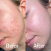 Maruderm Azaleic Acid Solution %10 Serum